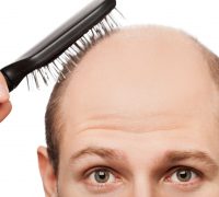 baldness