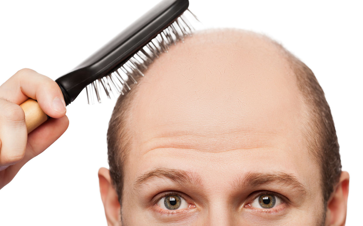 Tips On Combating Baldness From Steroid Use