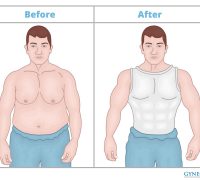 gynecomastia
