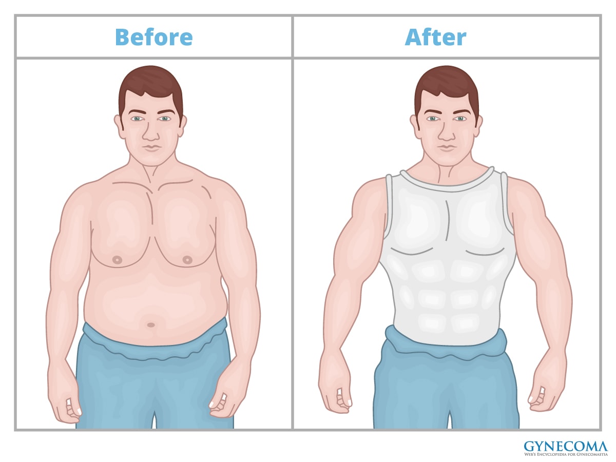 How To Recover From Gynecomastia
