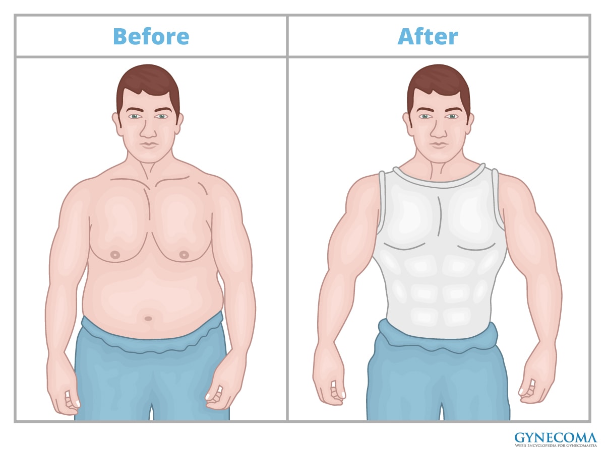 gynecomastia